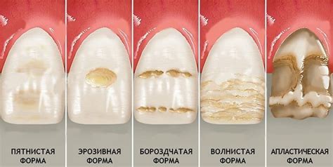 Заболевания десен и зубной эмали