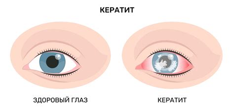 Заболевания и инфекции глаза