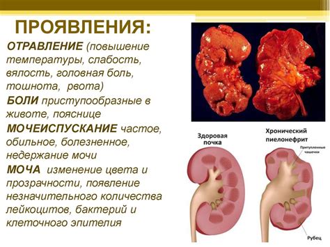 Заболевания органов выделительной системы