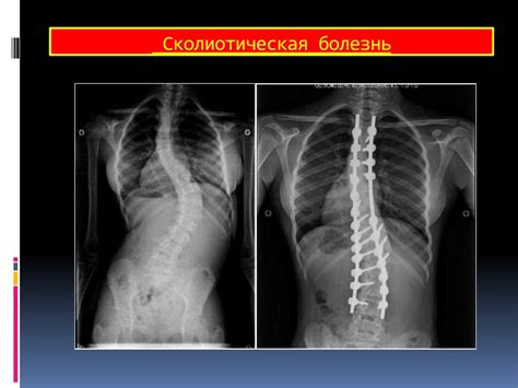 Заболевания позвоночника и грудной клетки