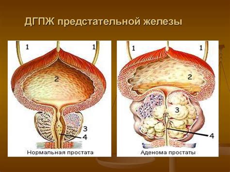 Заболевания простаты и их связь с повышенной вязкостью семени