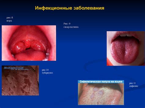 Заедание слизистой оболочки