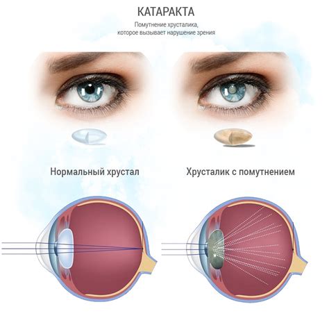 Закапывание тауфона при катаракте