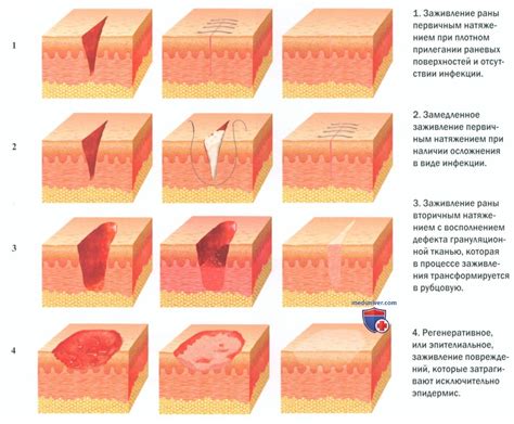 Замедляет заживление раны