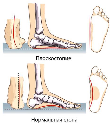 Здоровые стопы при плоскостопии: как поддержать физкультурой