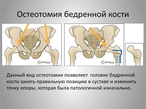 Значимость бедренного сустава для организма