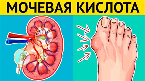 Избегайте факторов, которые способствуют накоплению мочевой кислоты