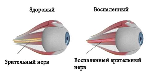 Инновационные методы восстановления глазного нерва