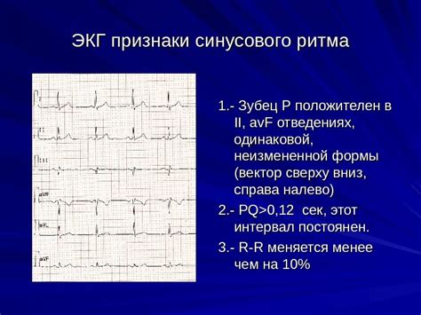 Инструкция по определению синусового ритма на ЭКГ