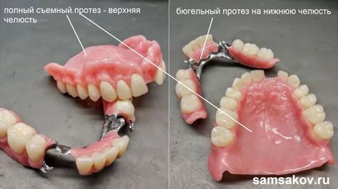 Искусственные протезы: альтернативный способ восстановления функции пальца