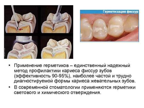 Использование йода для профилактики полости рта: надежный метод или потенциальный риск?