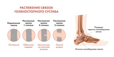 Использование разогрева связок в спорте