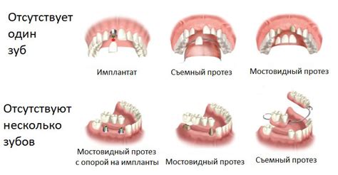 Использование специальных протезов и аппаратов