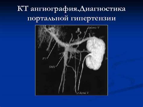 КТ-ангиография в диагностике портальной гипертензии