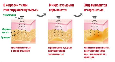 Кавитация и липосакция