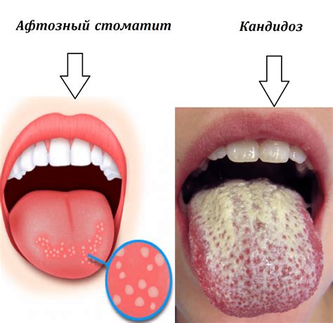 Какие факторы могут вызывать ощущение жжения во рту и на языке?