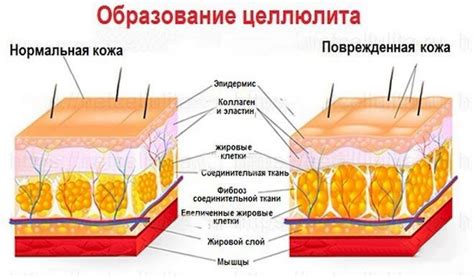 Каковыми бывают типы целлюлита