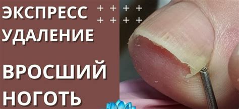 Как безболезненно удалить слезные железы: лучшие методы и советы