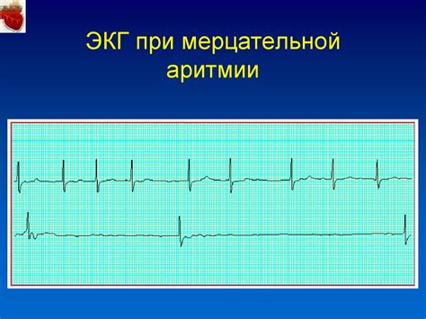 Как вернуть нормальное дыхание при мерцательной аритмии?