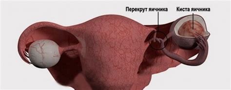 Как вернуть нормальный размер яичника после операции: советы и информация