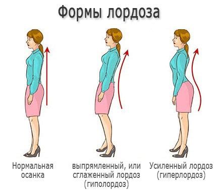 Как вернуть поясничный лордоз при выпрямлении