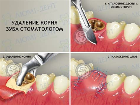 Как выбрать оптимальный метод удаления кисты в голове