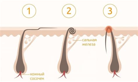 Как действовать при наличии вросших волос