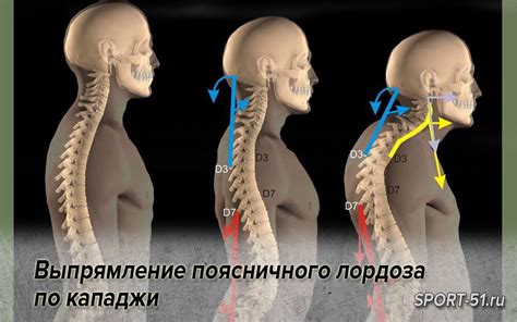 Как избавиться от поясничного лордоза: 4 способа восстановления здоровой осанки