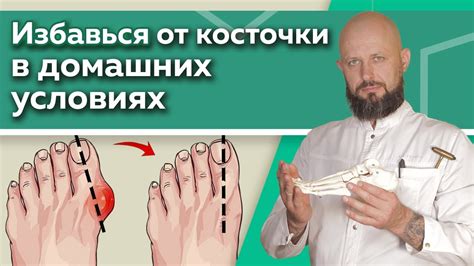 Как избавиться от шишки на ноге