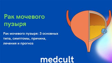 Как избежать проблем при применении пессария для лечения мочевого пузыря