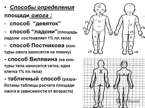 Как измерить площадь ожога