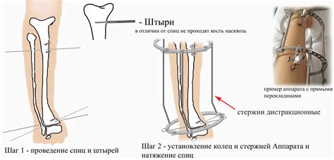 Как использовать аппарат Елизарова для остановки роста