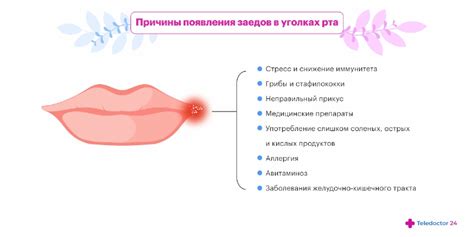 Как лечить заеды в уголках губ?