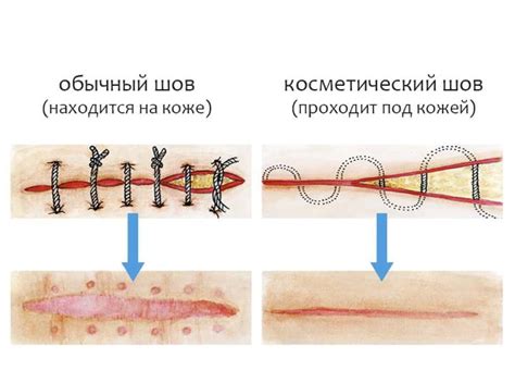 Как минимизировать рубцевание после удаления шва