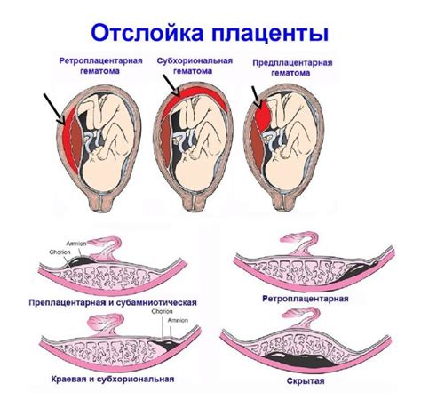 Как низкая плацентация влияет на процесс родов и здоровье ребенка