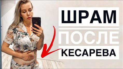 Как определить грыжу на животе после кесарева