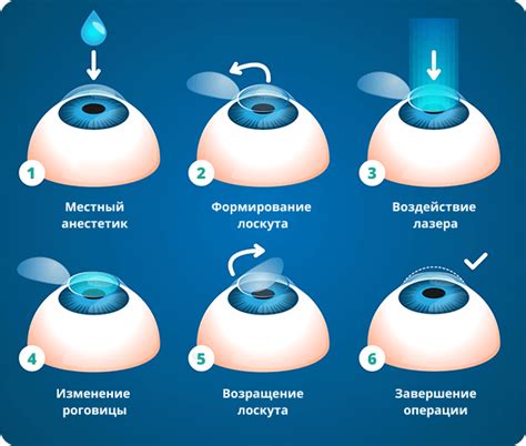 Как определить миопию после лазерной коррекции