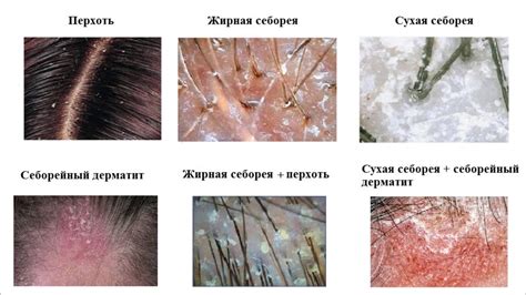 Как определить наличие перхоти?