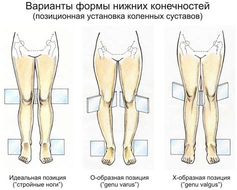 Как определить неправильную ось колена