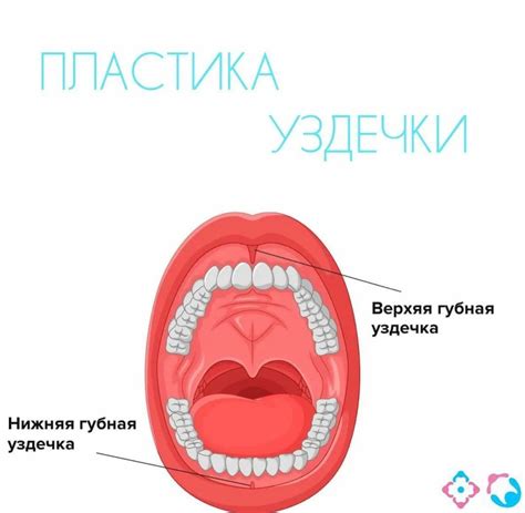 Как определить уздечку языка?