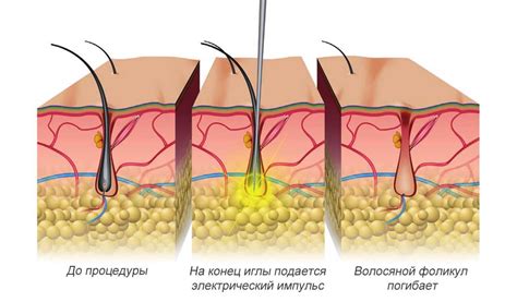 Как осуществляется электроэпиляция: различные методы и основные принципы процедуры