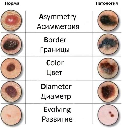 Как отличить доброкачественные родинки от вредных?