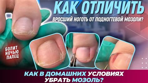 Как отличить мозоль от других проблем с ногтем?