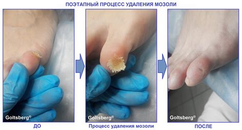 Как предотвратить образование твердой мозоли