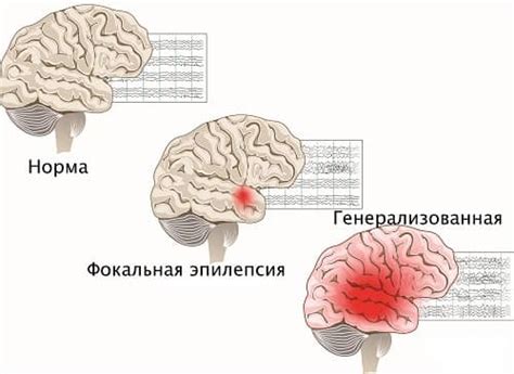 Как предотвратить пену изо рта при эпилепсии