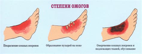 Как предотвратить шрам после ожога