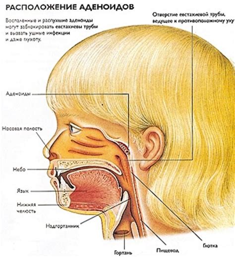 Как проходит операция по удалению аденоидов?