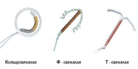 Как работает негормональная спираль - эффективный метод контрацепции