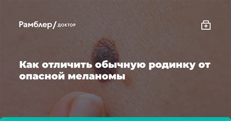 Как различить обычную родинку от опасной?