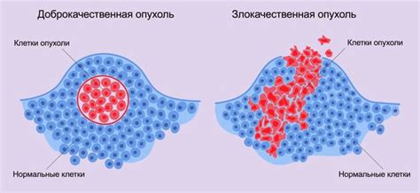 Как распознать миому: признаки злокачественной опухоли